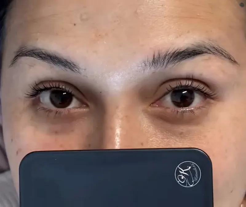 Browlift - Détail 2
